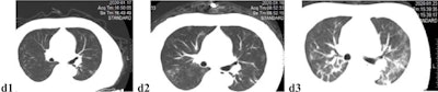Unenhanced axial CT images of a 52-year-old male doctor with asthma and exposure to patients with confirmed SARS-CoV-2 infection, initially presenting with fever, nonproductive cough, dyspnea, and myalgia, who rapidly progressed to a severe form requiring mechanical ventilation. (D1) Multifocal, limited ground-glass opacity in the periphery of both lungs, predominantly affecting left lung. (D2) Two days later, focal ground-glass opacity has increased in size and density, and new diffuse ill-defined ground-glass opacity has developed. (D3) After four days of mask oxygen supplementation, disease progressed further, with more patchy consolidations and linear densities observed in nearly all lung zones except the anterior part of both lungs. Images courtesy of European Radiology.