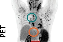 2020 04 18 01 48 5522 2020 04 17 Pet Hodgkins Lymphoma Mokrane 400