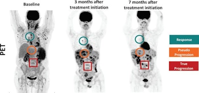PET images show example of partial hepatic pseudoprogressive lesions at the initial PET/CT scan of a 22-year-old male. Lesions size and metabolism progressed as the patient was treated with nivolumab. The lesions did not significantly alter response evaluation, as the patient experienced mixed response with true-progressive, pseudoprogressive, and complete-responding lesions. Images courtesy of Radiology.