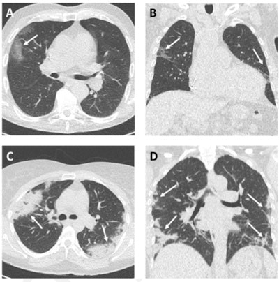 Example CT images in two patients with COVID-19. Axial (A) and coronal (B) CT imaging in an 85-year-old woman presenting with dyspnea and fever for three days. CT shows typical early COVID-19 findings with bilateral subpleural areas of ground-glass opacities (arrows). Effective radiation dose was 0.52 mSv. Axial (C) and coronal (D) CT images in a 41-year-old woman presenting with a cough and fever for 14 days. CT shows typical late COVID-19 findings with multifocal bilateral subpleural areas of consolidation (arrows). Effective radiation dose was 0.53 mSv. Images and caption courtesy of the RSNA.