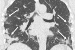 2020 04 22 21 55 9604 2020 04 23 Ldct Covid Figure 1 20200422214730