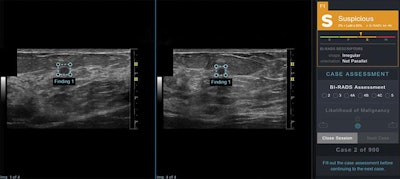 AI output scores were presented to study readers in graphical form as an electronic case report in conjunction with orthogonal ultrasound images of the lesion for that case. Right panel shows categoric assessment, in this case 'suspicious,' with triangle marker indicating confidence of assessment within that category. In this example, the AI software correctly classifies this lesion as suspicious; malignancy (invasive ductal carcinoma) was confirmed by ultrasound-guided biopsy. LoM = likelihood of malignancy, B = benign, P = probably benign, S = suspicious, M = probably malignant. Images and caption courtesy of the American Journal of Roentgenology.