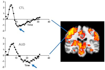Functional MR image (right) shows activation, especially in left sensorimotor cortex, in response to the finger-tap task. The hemodynamic response function (HRF) charts (left) show average fMRI response to finger-tap event averaged over 19 trials for each healthy control subject (CTL) and each subject with alcohol use disorder (AUD). Arrows indicate main finding of slower HRF among AUD subjects, which significantly correlated with the number of lifetime drinks consumed. Image set courtesy of John Desmond, PhD, et al.