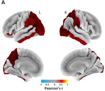 Three-dimensional overlay shows the regional pattern of statistically significant correlation between QSM and tau-PET values, including the inferior temporal gyrus. Images courtesy of Brain.