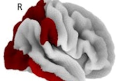 2020 04 27 22 23 4623 2020 04 28 Qsm Mri Pet Tau Overlay Spotorno 400