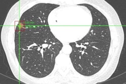 2020 04 30 17 39 8969 2020 04 30 Vuno Med Lung Ct Ai