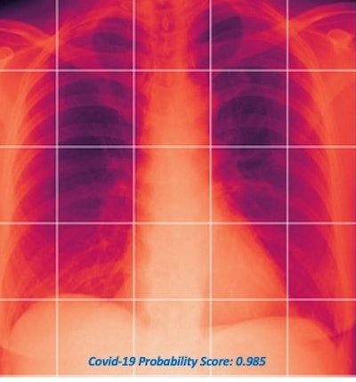 The MAIL2.0 AI model provides a probability score of 0 (low probability of COVID-19) to 1 (high probability) after analyzing chest radiographs. In this radiograph of a COVID-19 case, the model's probability score of 0.985 indicated a high probability of having the disease. Image courtesy of Dr. Michael Kuo.