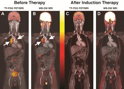 Concordant information with FDG-PET/MRI and whole-body DWI-MRI for monitoring treatment of diffuse large B-cell lymphoma. A, Coronal color-encoded fused FDG-PET/MRI scan and, B, color-encoded fused whole-body DWI-MRI scan obtained before chemotherapy in a 13-year-old boy with diffuse large B-cell lymphoma show FDG- and DWI-positive mediastinal lymph nodes (arrows). C, Coronal color-encoded fused FDG-PET/MRI scan and, D, color-encoded fused whole-body DWI-MRI image obtained after induction therapy show complete treatment response. Images courtesy of the RSNA.