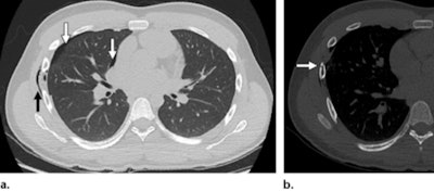 Chest wall injury in a 16-year-old adolescent boy with a direct handlebar injury to the right chest. (a) Axial CT image of the chest (lung window) demonstrates soft-tissue emphysema in the right lateral chest wall (black arrow) with a small right pneumothorax (white arrows). (b) Axial CT image (bone window) demonstrates a nondisplaced right sixth rib fracture (arrow). Images courtesy of the RSNA.