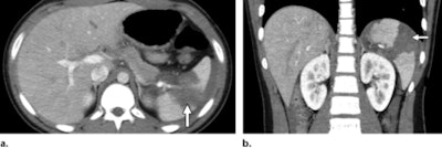 Splenic laceration in a 10-year-old child with a handlebar injury to the left upper quadrant. Axial (a) and coronal (b) contrast-enhanced CT images show a large disruption of the spleen (arrow) extending into the splenic hilum, a finding consistent with a grade 4 splenic laceration. Perisplenic free fluid and hemorrhage are also noted.