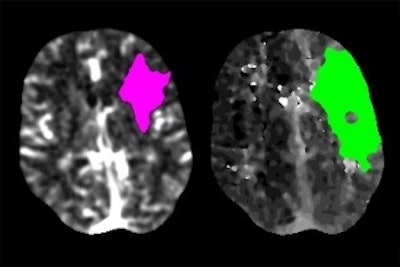 Scans of a stroke patient's brain show the area where tissue has died (magenta) and where tissue is damaged but may still be saved with prompt intervention (green). Image courtesy of Dr. Akash Kansagra.