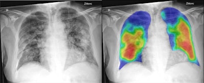 Frontal chest x-ray (left) of a 74-year-old male with positive RT-PCR test for SARS-COV-2 viral infection. The AI system's heat map (right) overlaid on the image showing the pneumonia-related features. The AI system score for this subject is 99.8. All images courtesy of Radiology.