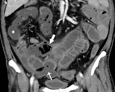 Axial (A) and coronal (B) CT of the abdomen and pelvis with IV contrast in a 57-year-old man with a high clinical suspicion for bowel ischemia. There was generalized small-bowel distension and segmental thickening (arrows), with adjacent mesenteric congestion (thin arrow in B), and a small volume of ascites (* in B). Findings are nonspecific but suggestive of early ischemia or infection. Images courtesy of Radiology.