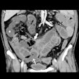 2020 05 12 20 38 9415 2020 05 12 Rsna Abdominal 400
