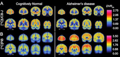 Part A shows average synaptic density measured with [11C] UCB-J PET in a group of participants with Alzheimer's disease (right) compared with a group of participants with normal cognition (left). Widespread reduction of synaptic density is present in the group with Alzheimer's disease (AD). Part B shows average amyloid accumulation measured with [11C]PiB PET in a group of participants with AD (right) compared with a group of participants with normal cognition (left). The cognitively normal group is devoid of amyloid and the AD group has extensive amyloid accumulation. Images courtesy of Adam Mecca and Alzheimer's & Dementia: The Journal of the Alzheimer's Association.