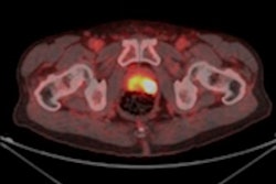2020 05 12 23 39 2894 2020 05 12 F 18 Psma Pet Ct Prostate Jnm 400