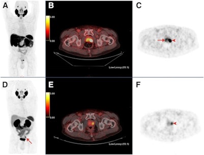 Maximum-intensity projections (MIP), transaxial fusion, and PET images of F-18-PSMA-1007 (A-C) and Ga-68-PSMA-11 (D-F) PET/CT scans from a 67-year-old patient with a Gleason score of 8 and prostate-specific antigen (PSA) score of 4.9 ng/mL. Marked uptake is seen in urinary bladder and left ureter (arrow) on MIP image of Ga-68-PSMA-11 (D), compared with nearly negligible F-18-PSMA-1007 urinary excretion (A). Dominant lesion in left prostatic lobe is evident on both scans (arrowheads). However, a second lesion is seen in right lobe only on 18F-PSMA-1007 scan (arrow in C), later verified on pathology as true malignant lesion. Images courtesy of the Journal of Nuclear Medicine.