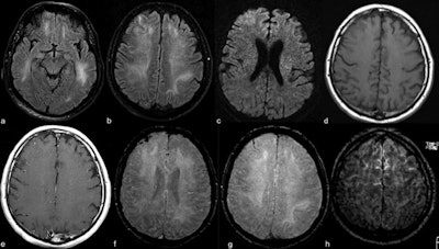 Contrast-enhanced cranial 1.5-tesla MRI examination of a 59-year-old intubated male patient with altered mental status despite tapering of sedoanalgesia. Axial FLAIR images at level of midbrain (a) and centrum semiovale (b) demonstrate prominent symmetric white matter hyperintensity and right frontal cortical hyperintensity. There is also prominent linear hyperintensity within frontal sulci. Axial b2000 DWI (c) shows frontal increased signal with corresponding low apparent diffusion coefficient (ADC) (images not provided). Axial T1-weighted imaging (T1WI) (d) shows right frontal sulcal effacement. Postcontrast T1WI (e) shows mild pial-subarachnoid enhancement. Axial susceptibility-weighted imaging (SWI) at the level of corona radiata (f) and centrum semiovale (g) demonstrates blooming artifact in the frontal sulci. Postcontrast FLAIR (h) depicts the bilateral leptomeningeal enhancement. Caption and images courtesy of the RSNA.