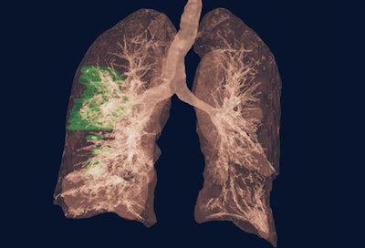 Clara COVID-19 AI Classification Model (for research use only). Image courtesy of Nvidia.