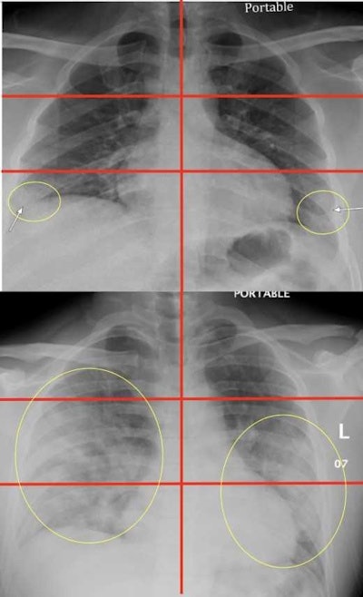 Top image: Chest radiograph of a 23-year-old male with no past medical history who tested positive for COVID-19 via reverse transcription polymerase chain reaction (RT-PCR) and was subsequently discharged from the emergency department with home care and isolation precautions. Portable chest x-ray shows right and left peripheral lower lung zone hazy opacities; total score = 2. Bottom image: Chest radiograph in a 32-year-old overweight (BMI = 30) male positive for COVID-19 with a history of childhood asthma who was subsequently admitted and intubated in the intensive care unit for three days. Portable chest x-ray shows opacities in all three right lung zones and in the left middle and lower lung zones; total score = 5. Images courtesy of Mount Sinai Health System.