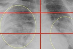 2020 05 14 19 11 7756 2020 05 14 Toussie Chest Xray 20200514191332