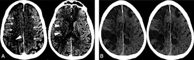 Image A: Noncontrast CT on the day of admission demonstrates subtle findings of acute ischemia in the right middle cerebral artery (arrowheads) and bilateral anterior cerebral artery (arrows) territories, including hypoattenuation and loss of gray-white differentiation. Image B: Repeat noncontrast CT on hospital day two demonstrates progression of acute infarcts in the right middle cerebral artery and bilateral anterior cerebral artery territories, including worsening edema and mass effect. Image courtesy of AJNR.