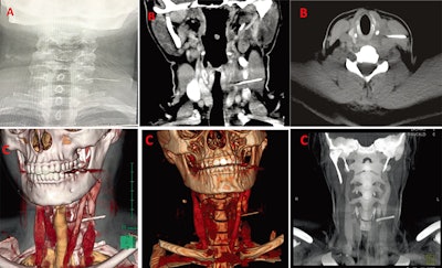 A: An x-ray showed a long, thin, and impinged foreign body. B: CT confirmed that the body was metallic and 3 cm in length. C: 3D reconstructed images were used for planning the removal of the needle. All images courtesy of Dr. Hassen Mohammed et al. Licensed under CC BY-NC 4.0.