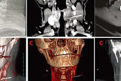 2020 05 18 19 08 7250 2020 05 19 Xray Swallowed Needle 20200518192032