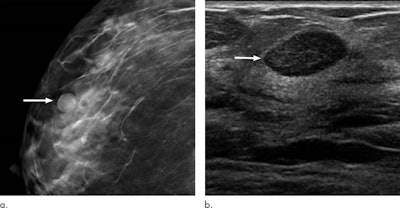(a) Craniocaudal tomosynthesis image shows a circumscribed mass at baseline screening mammography in a 40-year-old woman due to a biopsy-confirmed fibroadenoma. (b) Targeted transverse ultrasound image shows a circumscribed hypoechoic mass, a BI-RADS 3 finding. Image courtesy of Radiological Society of North America.