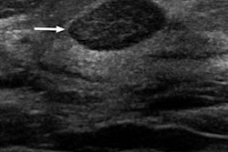 2020 05 18 22 24 2630 2020 05 19 Radiology Bi Rads 3 Image 20200518220501