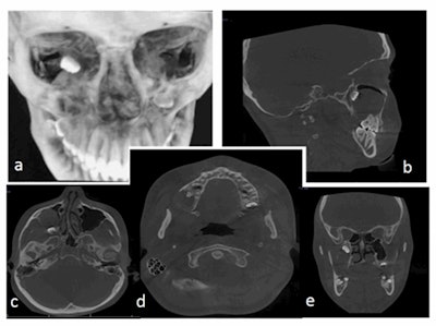 Multiplanar CBCT sections: (a) three-dimensional, (b) sagittal, (c, d) axial, and (e) coronal slices showing the posterosuperior position of the ectopic molar inside the maxillary sinus with associated lesion that surrounds the crown of the tooth. All images courtesy of Khairy Elmorsy, DMD, et al. Licensed under CC BY-NC 4.0.