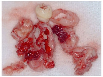 The removed underdeveloped ectopic molar and cystic lining.