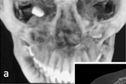 2020 05 21 16 18 3588 2020 05 20 Ectopic Tooth Cbct 20200519164454