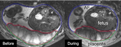 The relaxed placenta before the utero-placental pump contraction (left) and during the contraction (right). The placenta is the area surrounded by the red line. Image courtesy of Neele Dellschaft, PhD, and the University of Nottingham.
