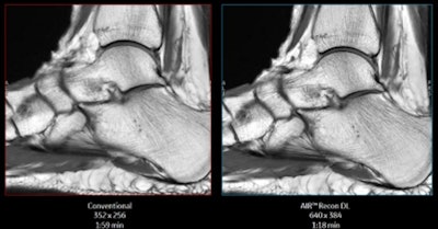 GE's AIR Recon DL delivers shorter scans and better image quality. Image courtesy of GE Healthcare.