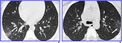 8-year-old boy with COVID-19. A and B, Unenhanced chest CT scans show minimal ground-glass opacification (right lower and left upper lobes) (arrows) and no consolidation. Only two lobes were affected, and CT findings were assigned a CT severity score of 2. Images courtesy of the American Journal of Roentgenology.