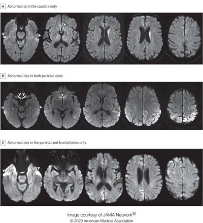 A: A man in his 70s with sCJD subtype VV2 with signal hyperintensity in the body of the left caudate, without evidence of signal abnormality in the putamina and neocortical ribbon. B: A woman in her 60s with sCJD subtype MM1 with signal hyperintensity in the cortical ribbon of both parietal lobes, left greater than right, and left precuneus without evidence of abnormality in the striatum, thalami, and cortical ribbon of the temporal and occipital lobes. C: A woman in her 70s with sCJD subtype MM1 with signal hyperintensity in the precuneus (right greater than left) and right parietal cortex. Images courtesy of JAMA Neurology.