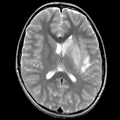 2020 06 02 21 37 5222 2020 06 03 Pediatric Stroke Covid Figure1 A