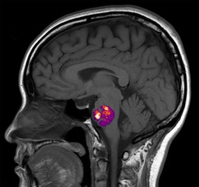 A National Institutes of Health-funded study found a link between the appearance of abnormal, stroke-inducing blood vessel bundles, called cavernous angiomas, and the composition of a person's gut bacteria. Image courtesy of the University of Chicago.