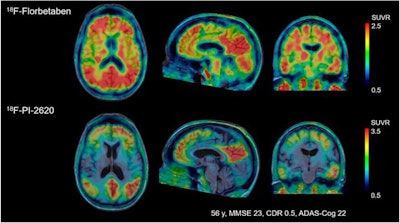 Images compare florbetaben amyloid-PET (top row) and F-18-PI-2620 tau PET (bottom row) obtained in same subject who had a clinical dementia rating (CDR) of 5. Images were normalized to cerebellar gray matter and coregistered to subject's MR images. Images courtesy of Journal of Nuclear Medicine.