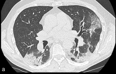Segmental acute pulmonary embolism in patients with COVID-19: One was a 61-year-old man presenting to the emergency department for fever and myalgia during nine days with new onset of dyspnea without desaturation. The RT-PCR for SARS-CoV-2 was positive. Unenhanced chest CT scan (a) revealed typical COVID-19 pneumonia with mild lung involvement. CTPA in axial (b) and coronal reformation (c) showed a segmental acute pulmonary embolism of the right lower lobe (arrows). After two days of hospitalization, the patient was discharged at home with a good outcome. Caption and images courtesy of European Radiology.