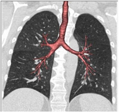 These CT scans of lung airways (red) and lungs (black) show the spectrum of dysanapsis, with smaller airways in proportion to lung size (above) compared with normal size airways (below, left) and larger than normal airways (below, right). Images courtesy of VIDA Apollo Software via contributing author Eric Hoffman, PhD, of the University of Iowa in Iowa City.
