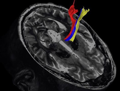 Diffusion tractography uses the movement of water molecules to identify tracts that connect different parts of the brain. It can be used to pinpoint the part of the thalamus to treat with focused ultrasound. Image courtesy of the University of Texas Southwestern Medical Center.