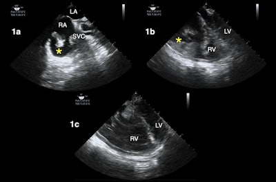 TEE during cardiac arrest resuscitation in a patient with COVID-19. The asterisks in image 1a and 1b highlight right atrial thrombus. Image 1c shows a dilated right ventricle (RV) and septal deviation during a pause in CPR. All images courtesy of the JASE.