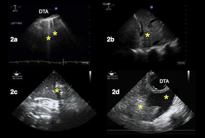 TELUS of patients with hypoxemia. In image 2a, the asterisks correspond to B-lines, suggesting increased extravascular lung water. In images 2b and 2c, the asterisks denote consolidation patterns, suggesting atelectasis instead of pneumonia. In image 2d, the left asterisk highlights an atelectatic lung, and the right asterisk points to a pleural effusion.