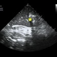 2020 06 17 23 17 2935 2020 06 18 Tee Lung Ultrasound 20200617233133