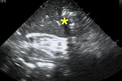 2020 06 17 23 17 2935 2020 06 18 Tee Lung Ultrasound 20200617233133