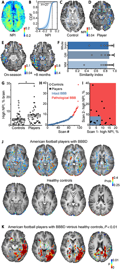 This DCE-MRI scan reveals persistent blood-brain barrier disorder in American football players. Using brain imaging techniques and analytical methods, researchers can determine whether football players have CTE by measuring leakage of the blood-brain barrier. Image courtesy of Ben-Gurion University.