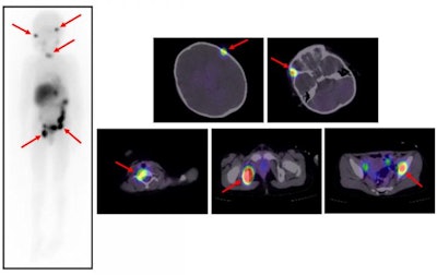 Scintigrams at 131I-MIBG therapy. Multiple 131I-MIBG accumulations are seen in bone metastases (red arrows). β rays emitted from 131I-MIBG attack tumor cells in the bone metastases. Image courtesy of Kanazawa University.