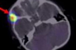 2020 06 22 22 32 6534 2020 06 22 Neuroblastoma 20200622220505